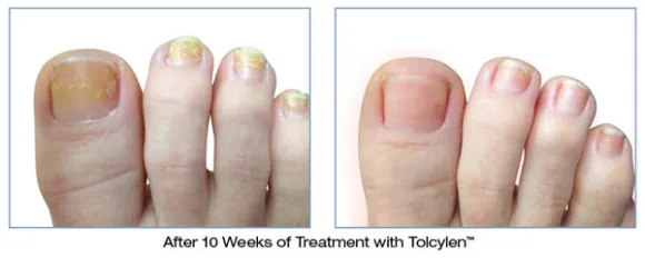 Tolcylen at The Podiatry Doctors