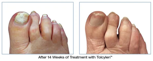 Tolcylen at The Podiatry Doctors